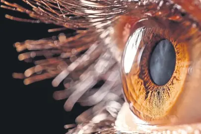 Göz içi tümörüne radyoaktif plak tedavisi