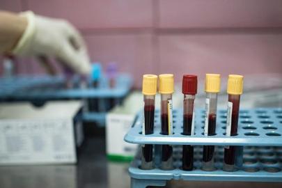 Dünyada her yıl 20 milyon, Türkiye'de ise 240 bin kişi kanser tanısı alıyor