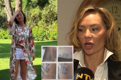 Şişli'de estetik yaptırmak isteyen mankenin vücudu yandı