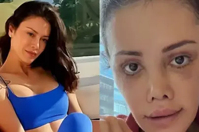 Yüz nakli yaptıran Didem Ceran'ın son hali: Harika gözüküyorum