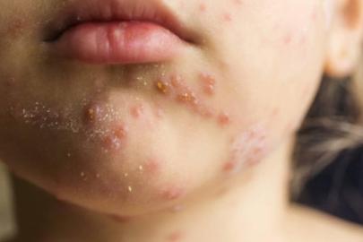 Prof. Dr. Kara'dan kızamık uyarısı: Bir kişi 18 kişiye bulaştırabilir