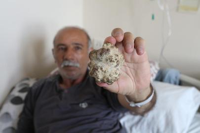 Doktorları şaşırttı: Elma büyüklüğünde taş çıktı